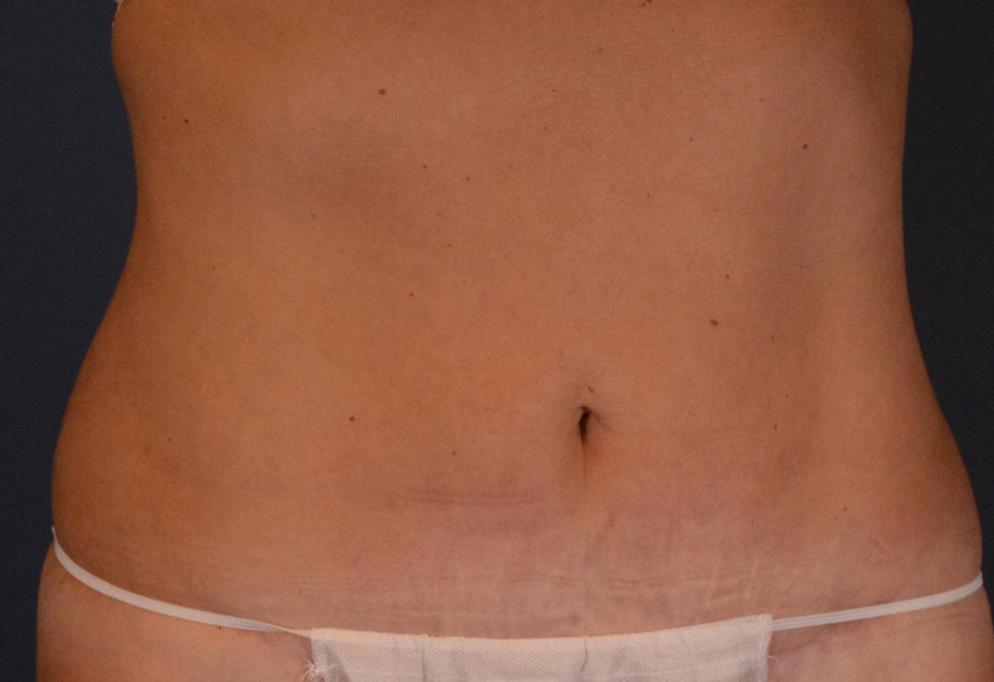 Liposuction: Case I21A After