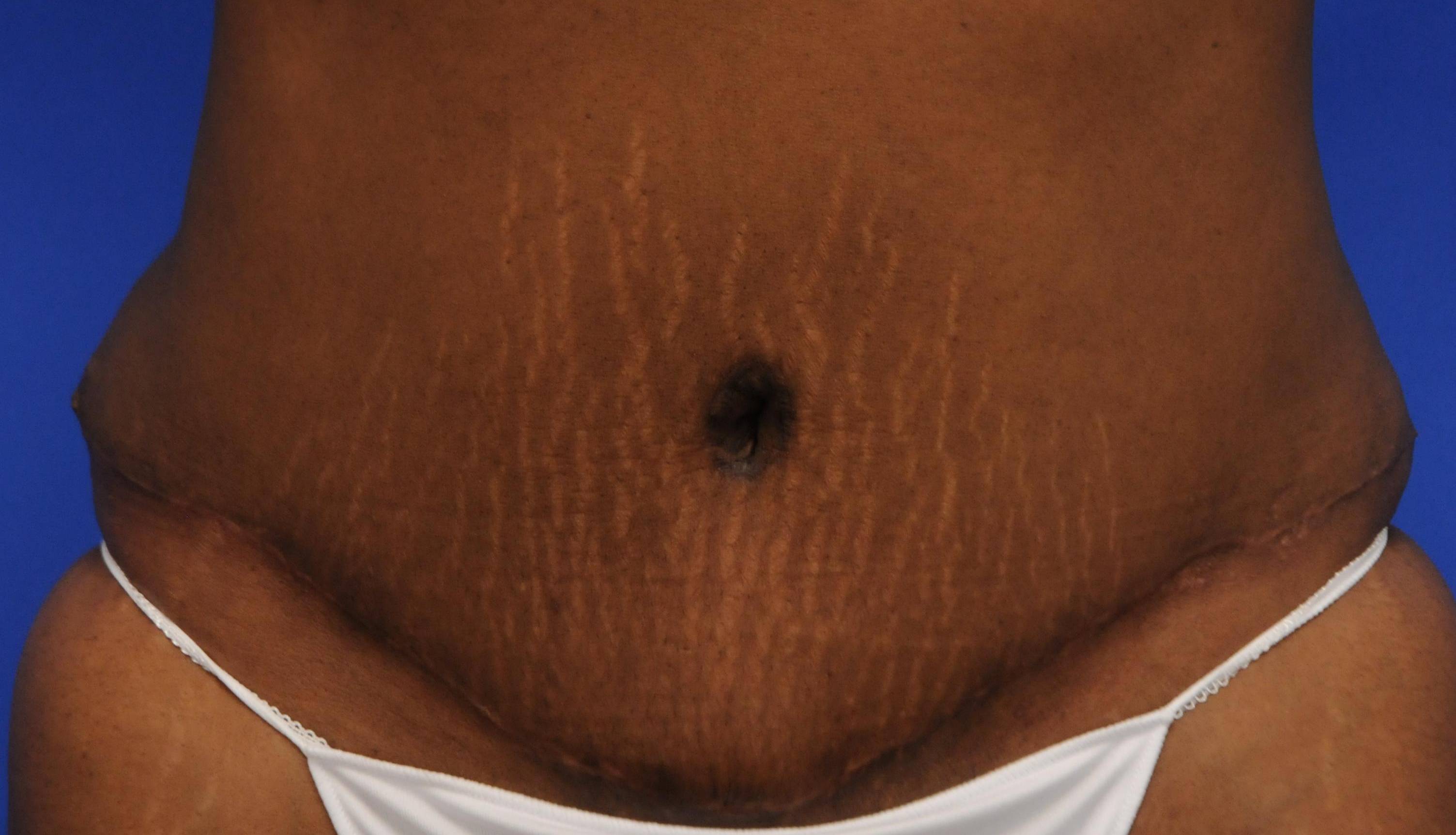 Tummy Tucks (Abdominoplasties): Case I3 After