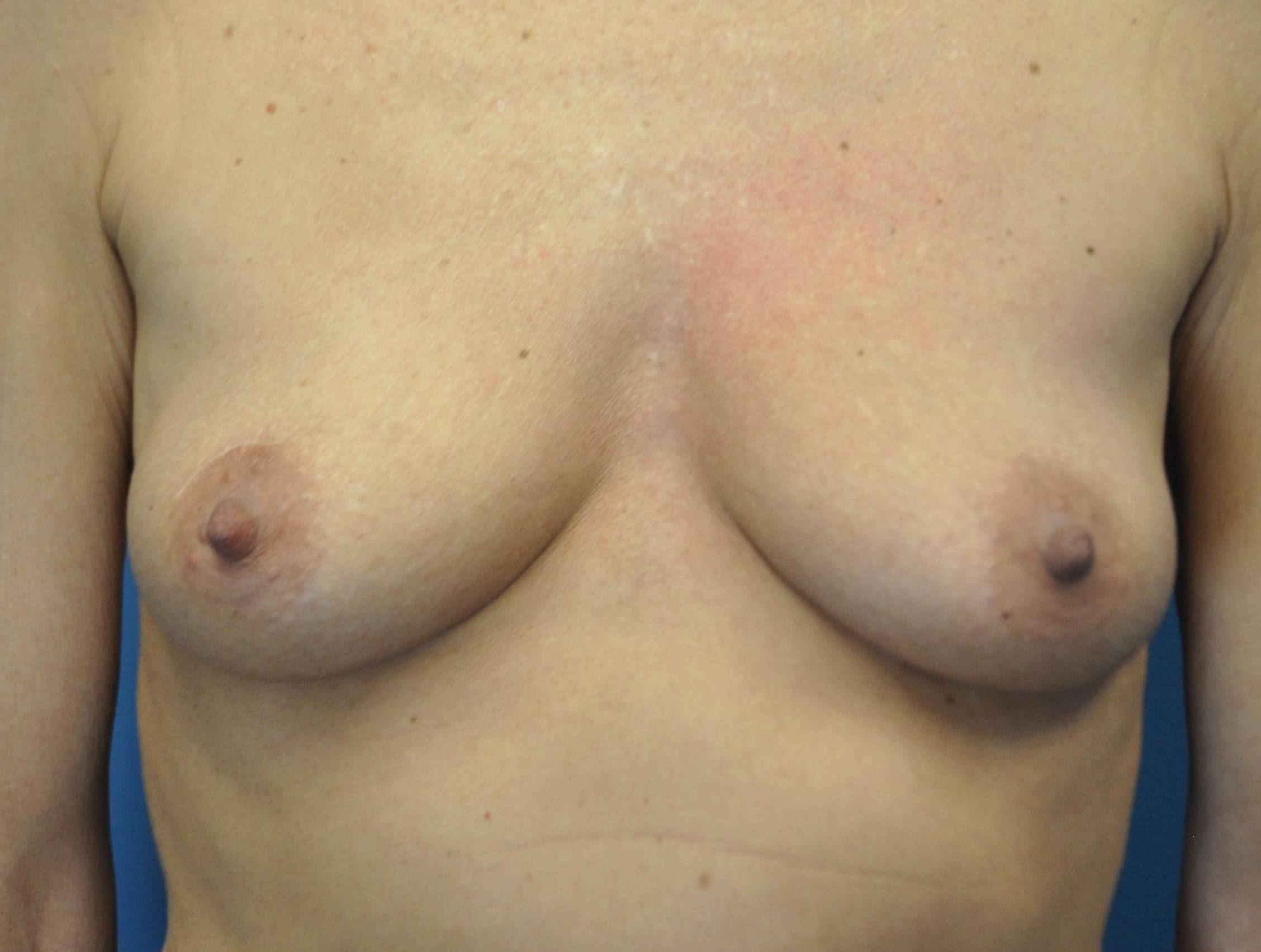 Breast Reconstruction with Implants: Case L19 Before