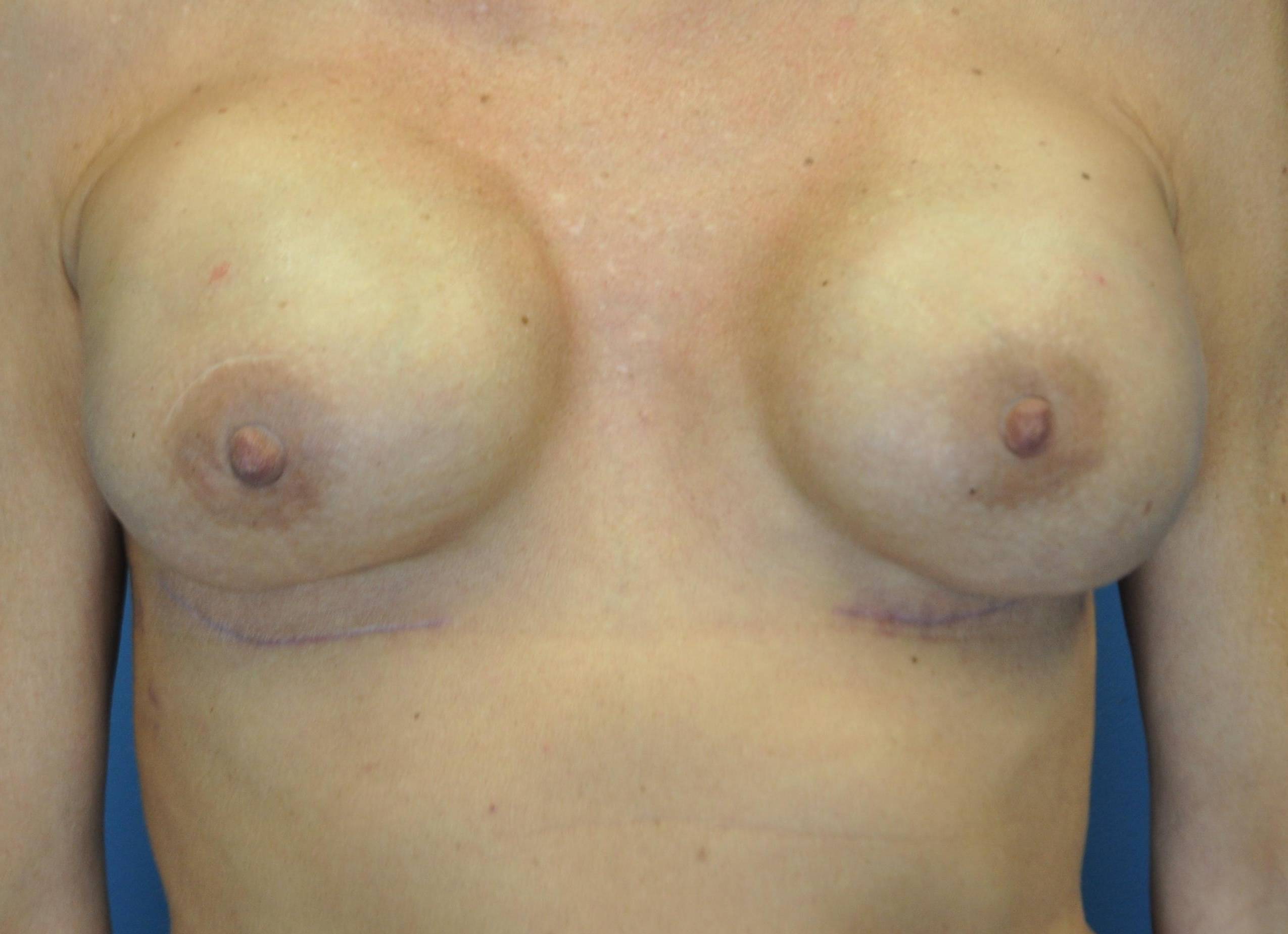 Breast Reconstruction with Implants: Case L19 After