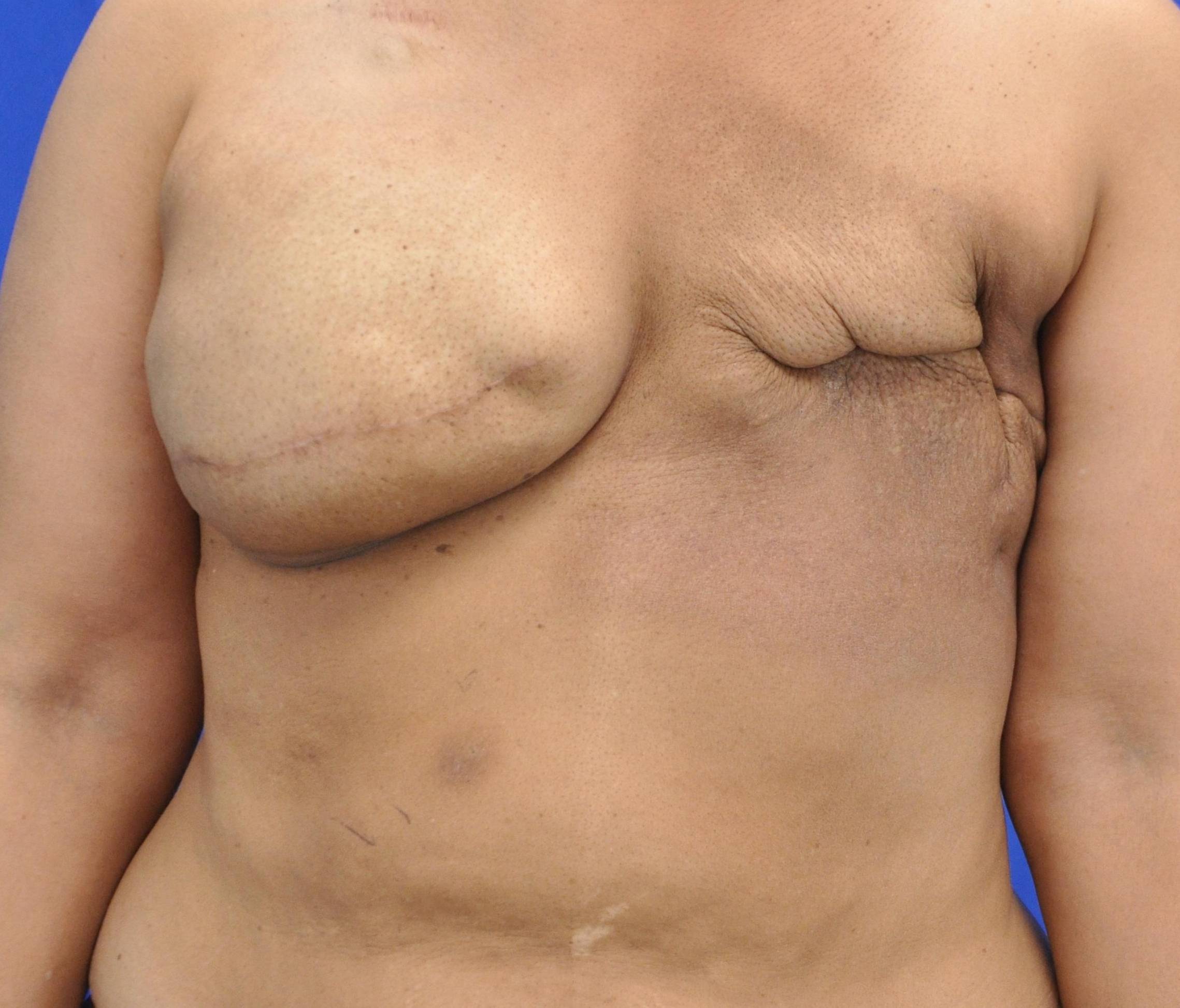 Breast Reconstruction with Implants: Case L31 Before