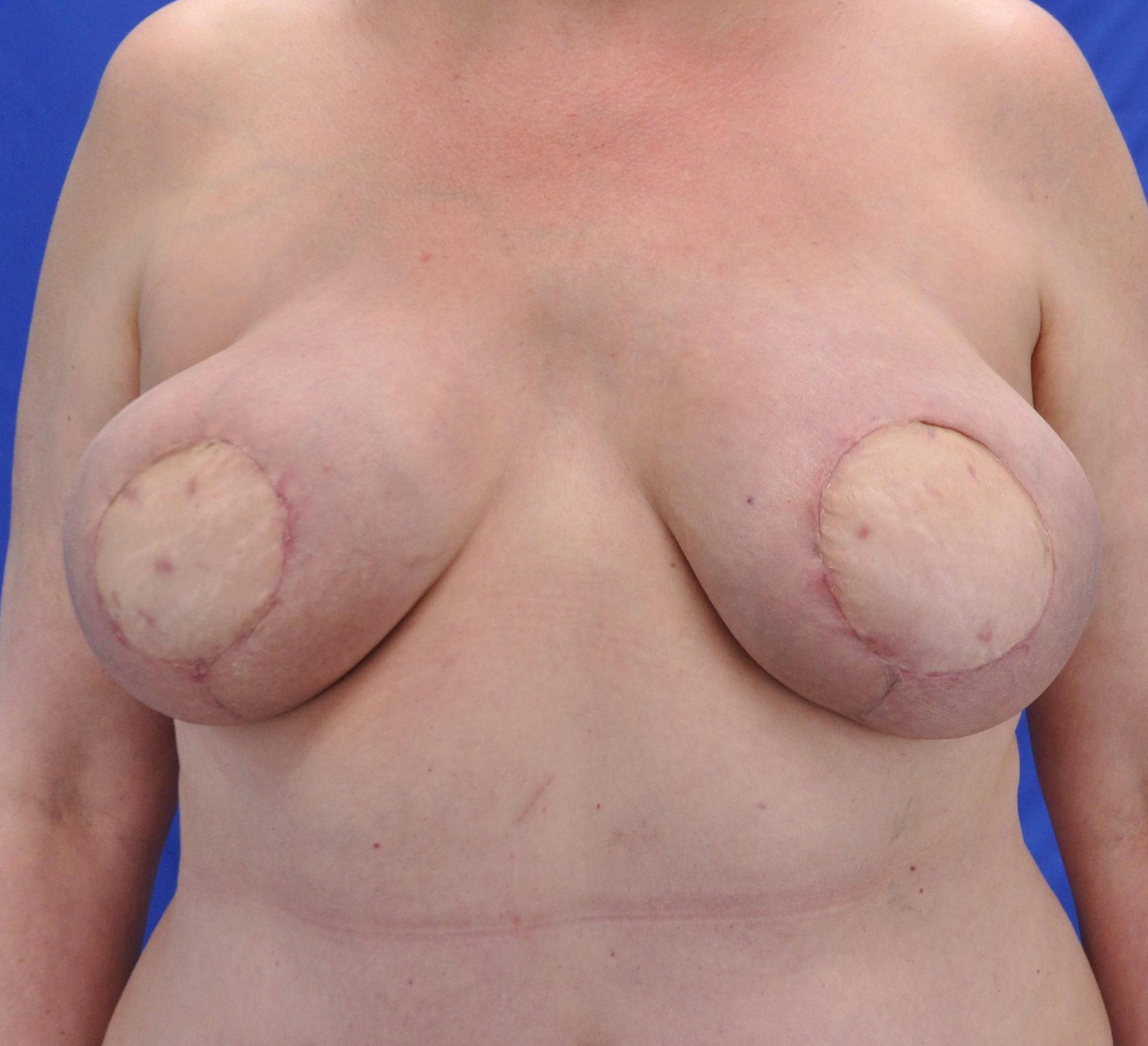 Breast Reconstruction with Your Own Tissue: Case M23 After
