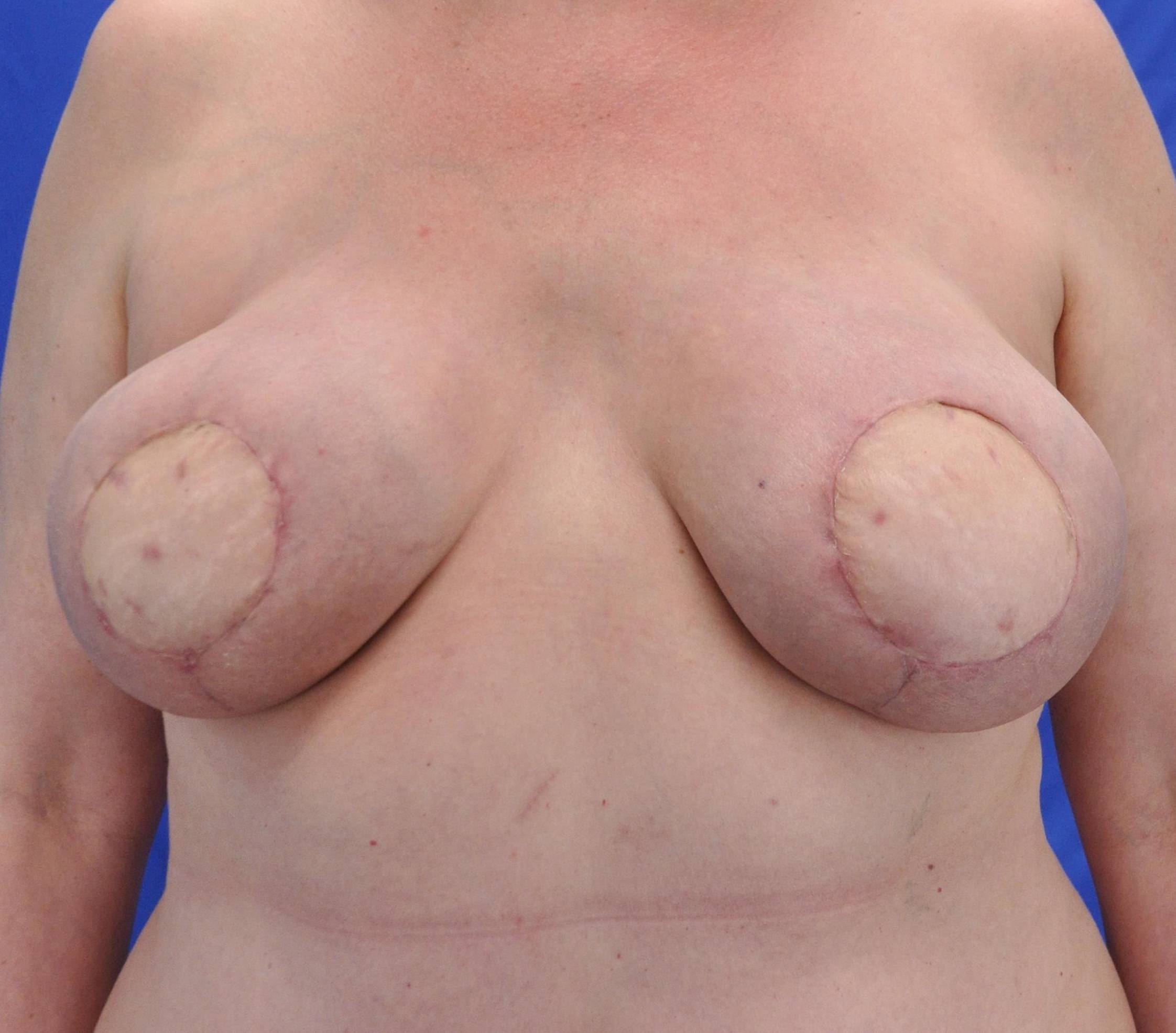 Nipple Reconstruction and Correction: Case W2 Before