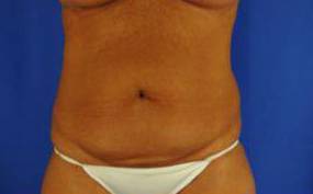Tummy Tucks (Abdominoplasties): Case B1 Before