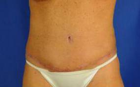 Tummy Tucks (Abdominoplasties): Case B1 After