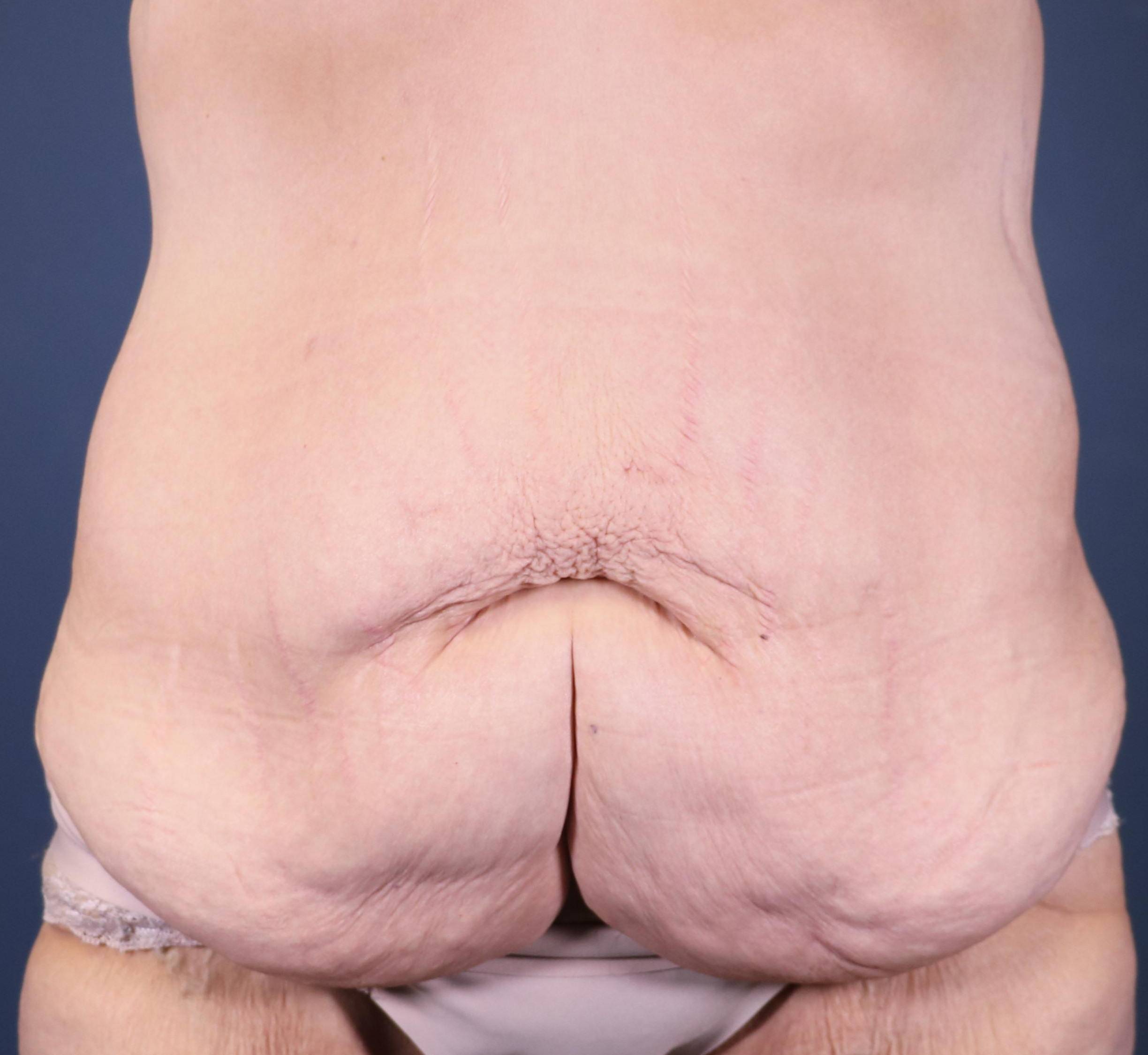 Tummy Tucks (Abdominoplasties): Case I23 Before