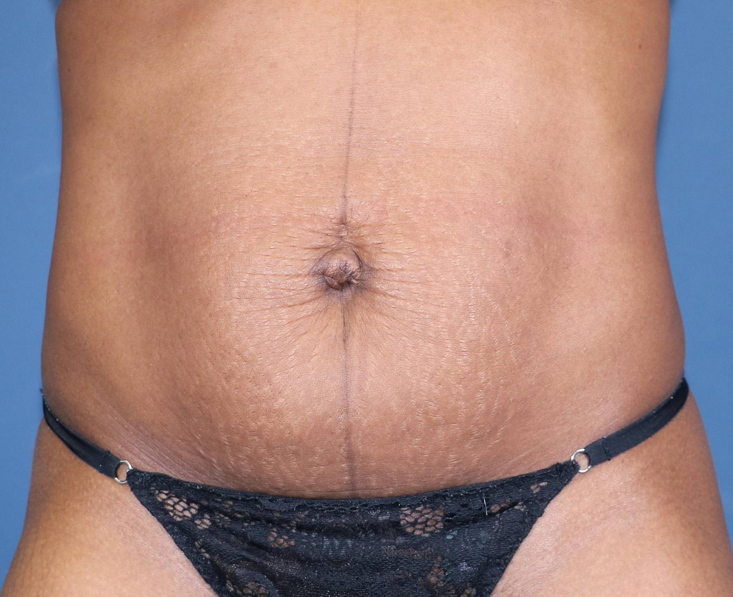 Tummy Tucks (Abdominoplasties): Case I22 Before