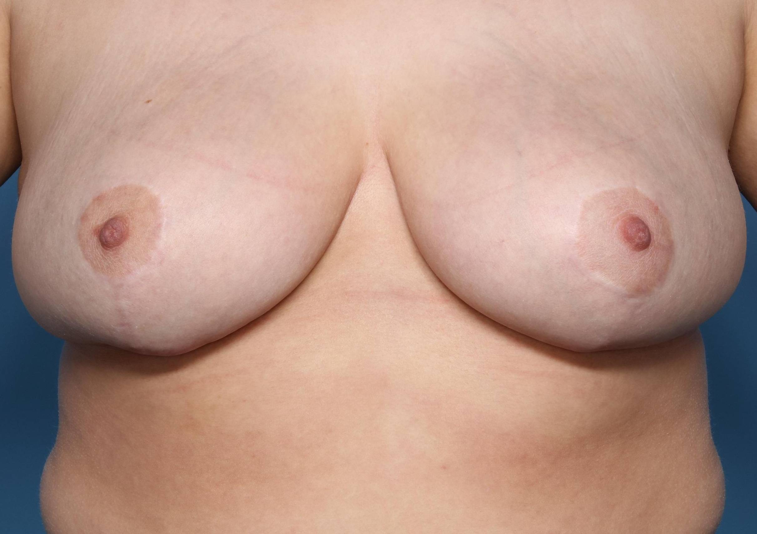 Breast Reductions: Case BRD4 After
