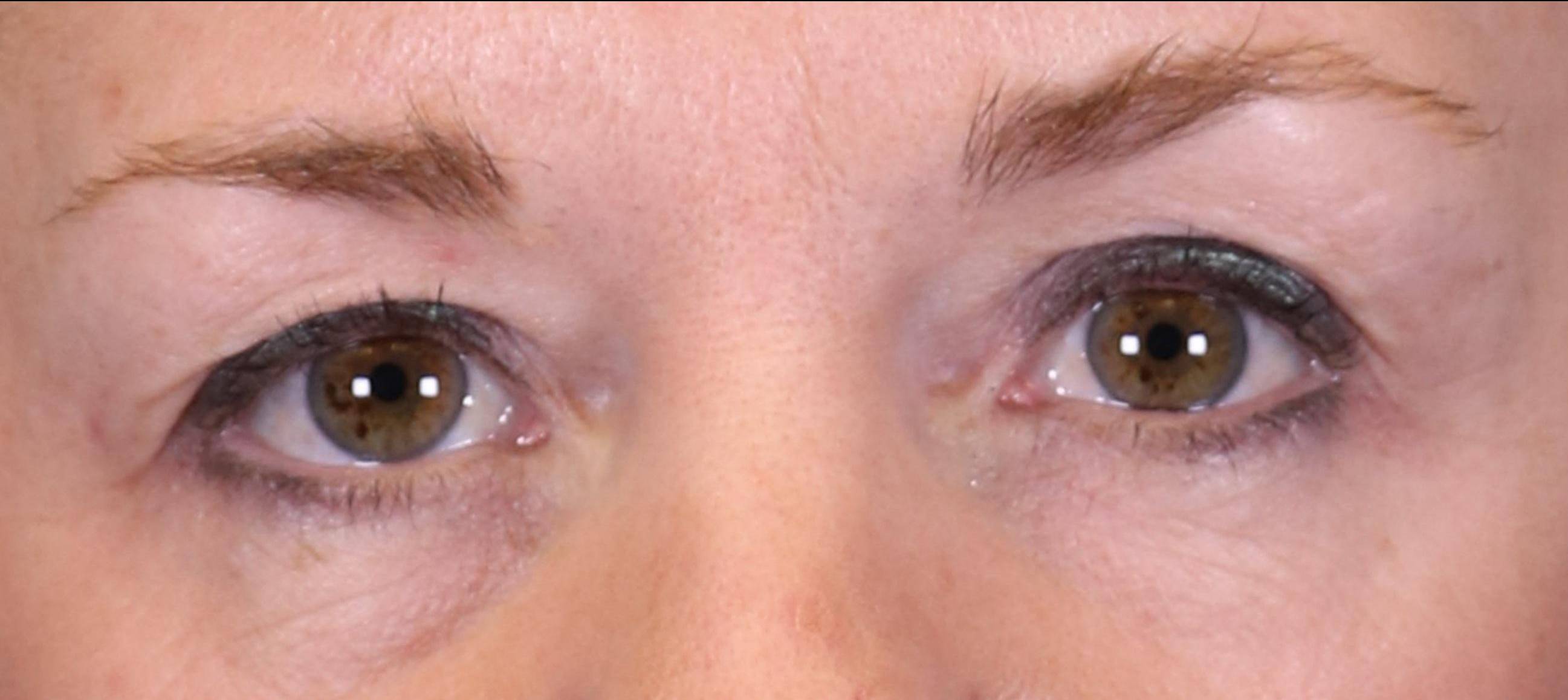 Eyelid Surgery and Forehead (Brow) Lifts: Case S5 After