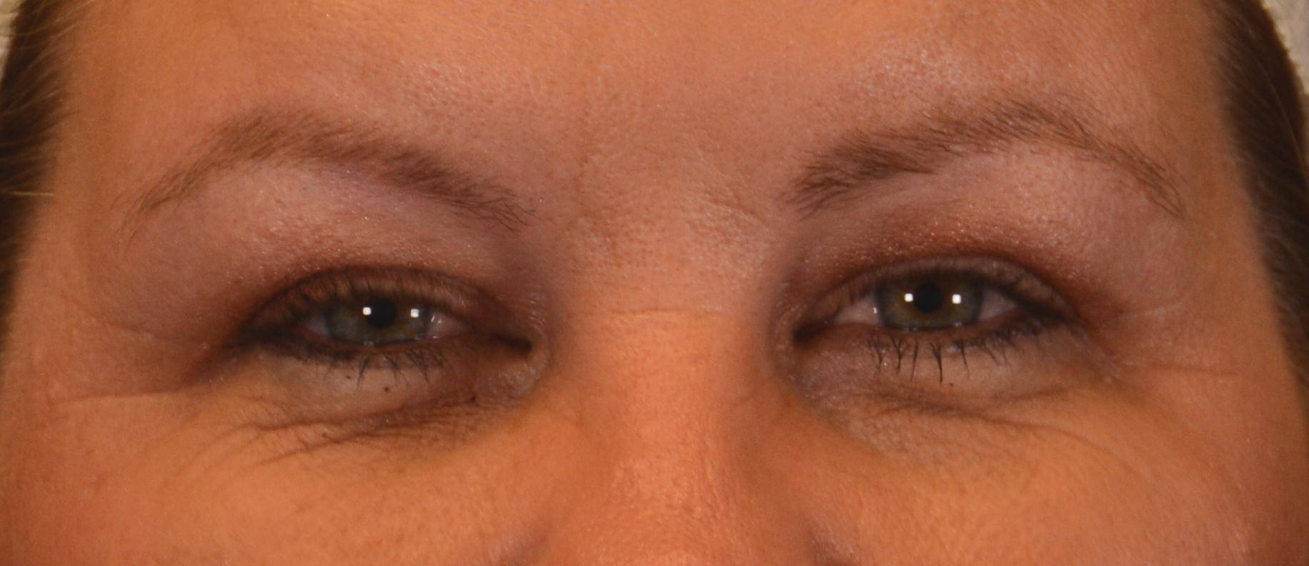 Eyelid Surgery and Forehead (Brow) Lifts: Case M30 After