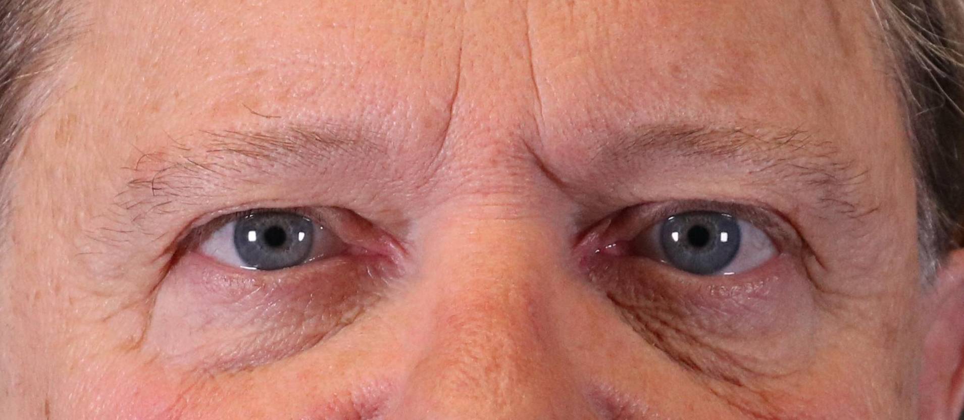Eyelid Surgery and Forehead (Brow) Lifts: Case S3 Before