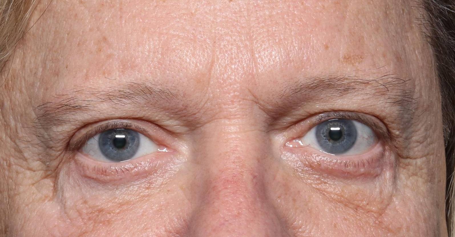 Eyelid Surgery and Forehead (Brow) Lifts: Case S3 After