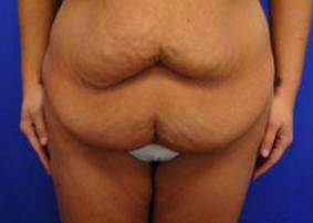 Tummy Tucks (Abdominoplasties): Case B2 Before