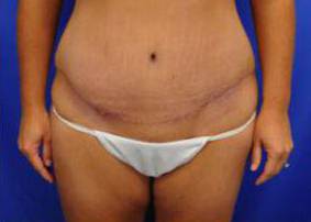 Tummy Tucks (Abdominoplasties): Case B2 After