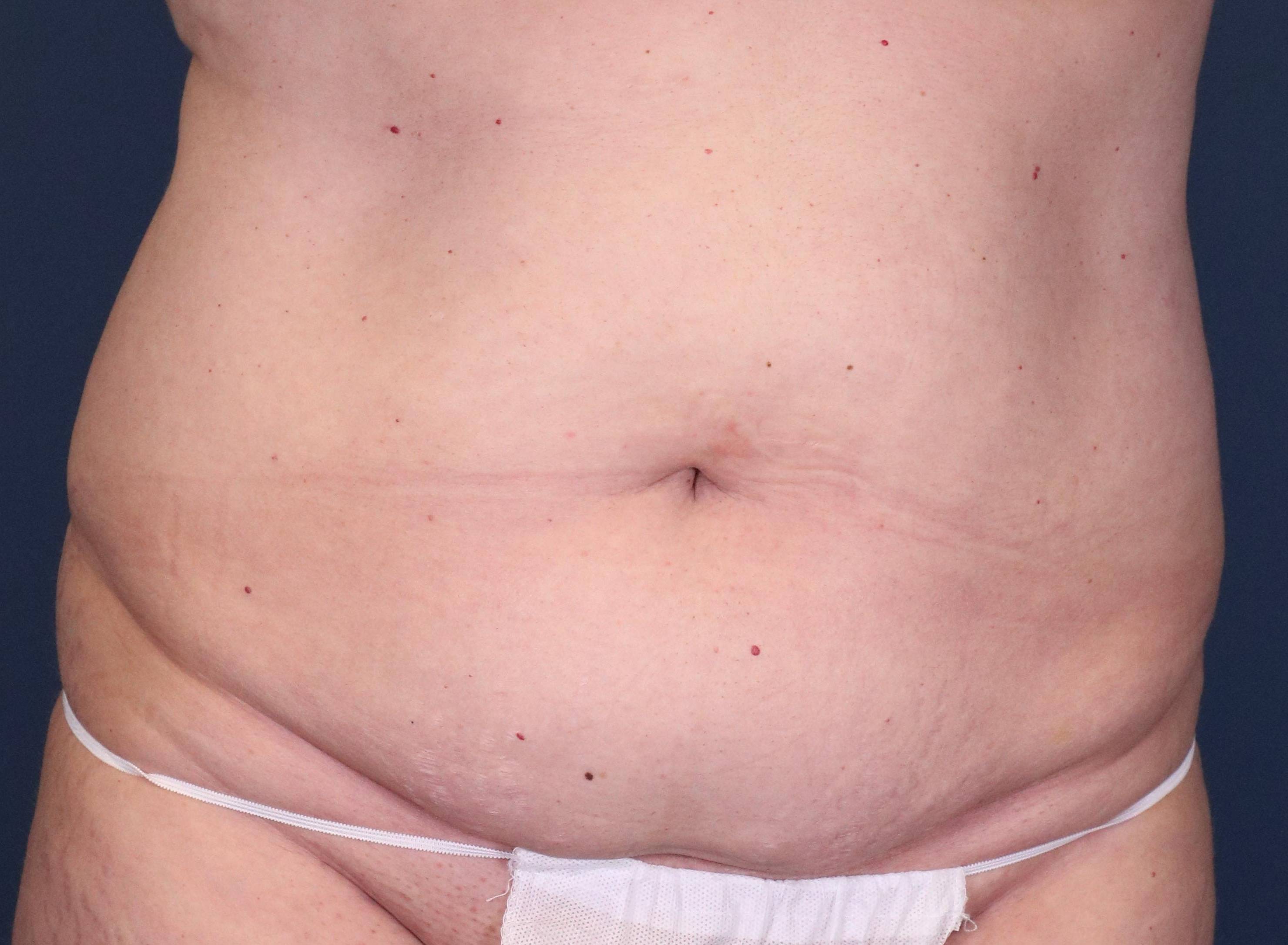 Tummy Tucks (Abdominoplasties): Case I26 Before