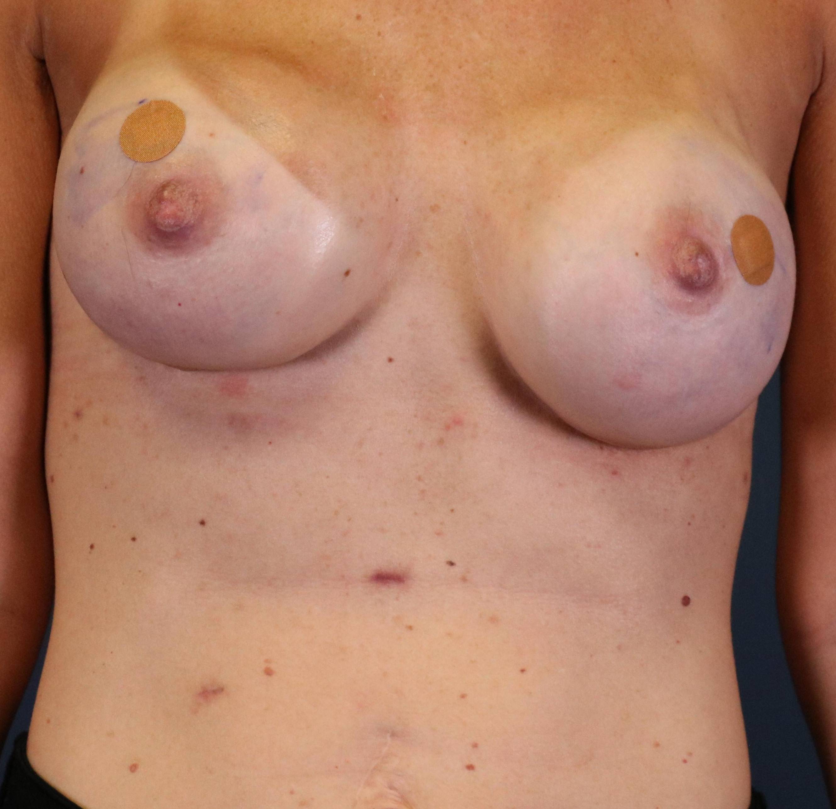 Breast Reconstruction with Implants: Case L81 Before