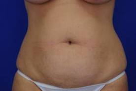 Tummy Tucks (Abdominoplasties): Case B16 Before