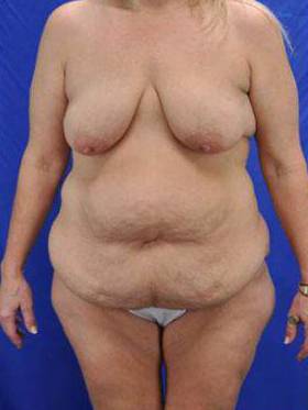 Tummy Tucks (Abdominoplasties): Case B24 Before
