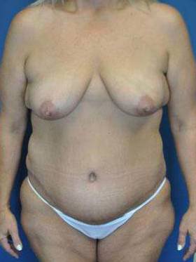 Tummy Tucks (Abdominoplasties): Case B24 After
