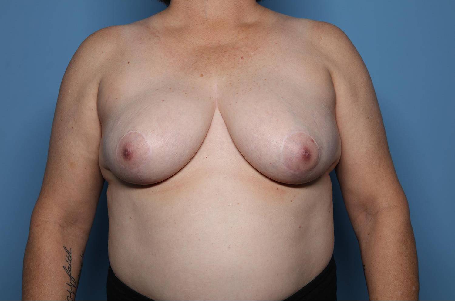 Breast Reductions: Case BRD7 After