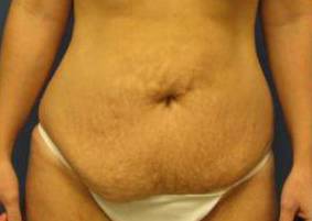 Tummy Tucks (Abdominoplasties): Case I4 Before
