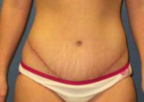 Tummy Tucks (Abdominoplasties): Case I4 After