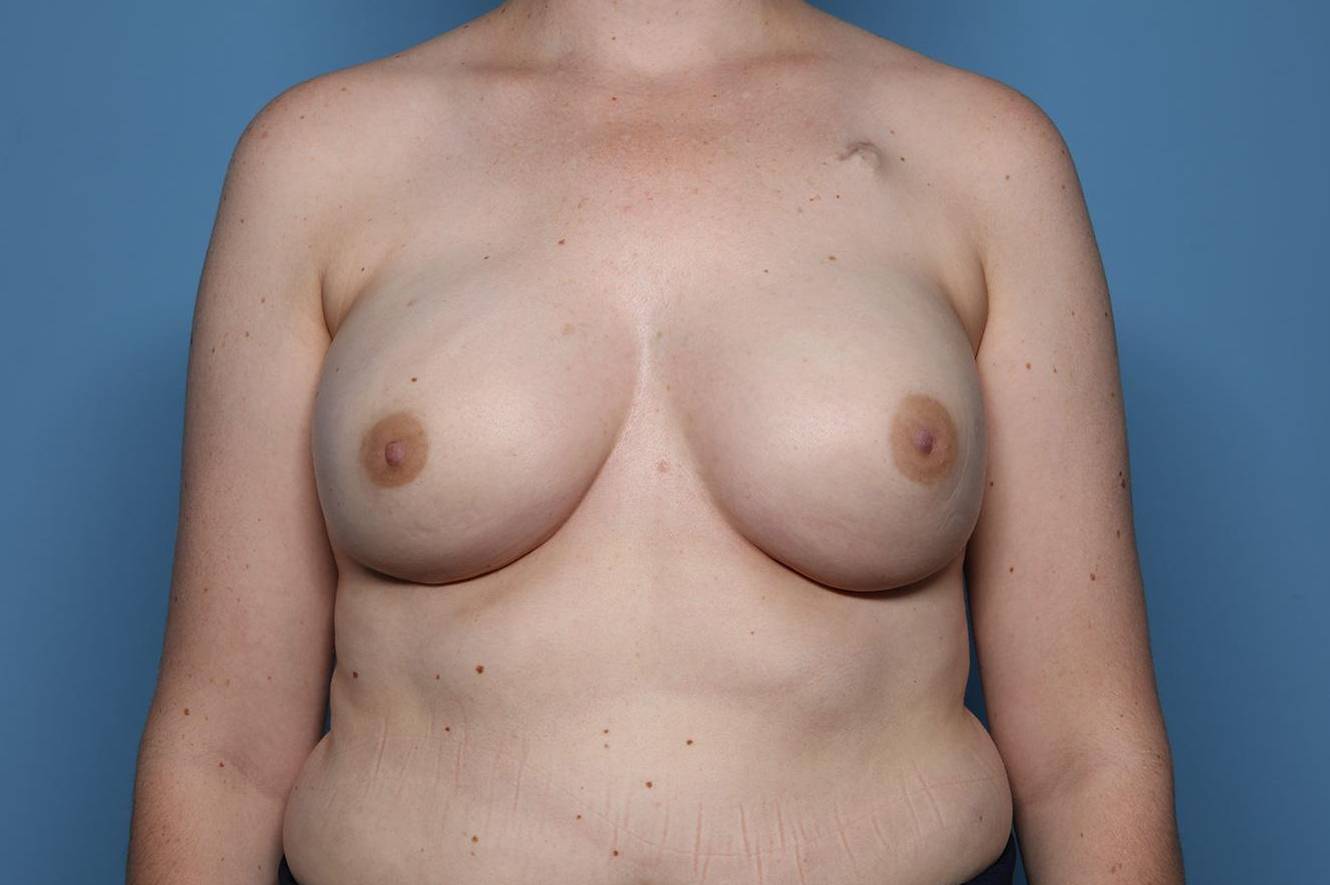Breast Reconstruction with Implants: B29 After