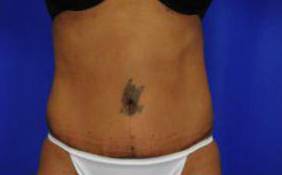 Tummy Tucks (Abdominoplasties): Case I6 After