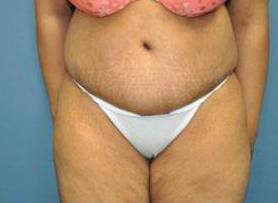 Tummy Tucks (Abdominoplasties): Case I9 After