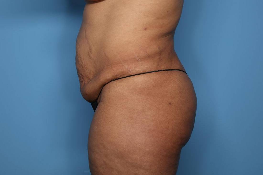 Tummy Tuck (Abdominoplasties): Case TT7 Before
