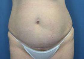 Tummy Tucks (Abdominoplasties): Case I10 Before