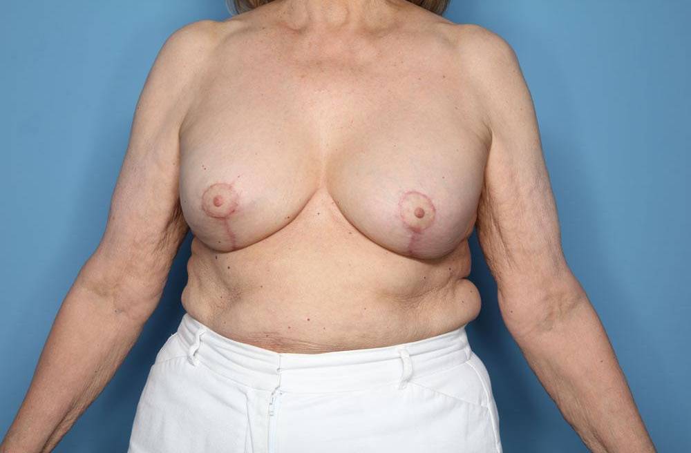 CORRECTIVE BREAST SURGERY: CASE CBS1 After