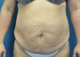 Tummy Tucks (Abdominoplasties): Case I14 Before