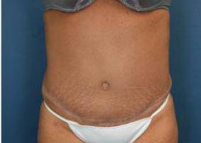 Tummy Tucks (Abdominoplasties): Case I14 After