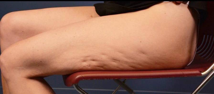 Cellulite Reduction : Cellfina Before