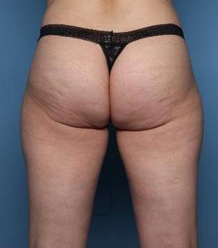 Cellulite Reduction : Aveli Before