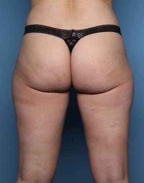 Cellulite Reduction : Aveli After