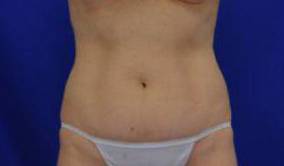Tummy Tucks (Abdominoplasties): Case A1 Before