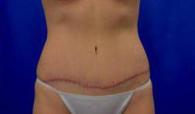 Tummy Tucks (Abdominoplasties): Case A1 After