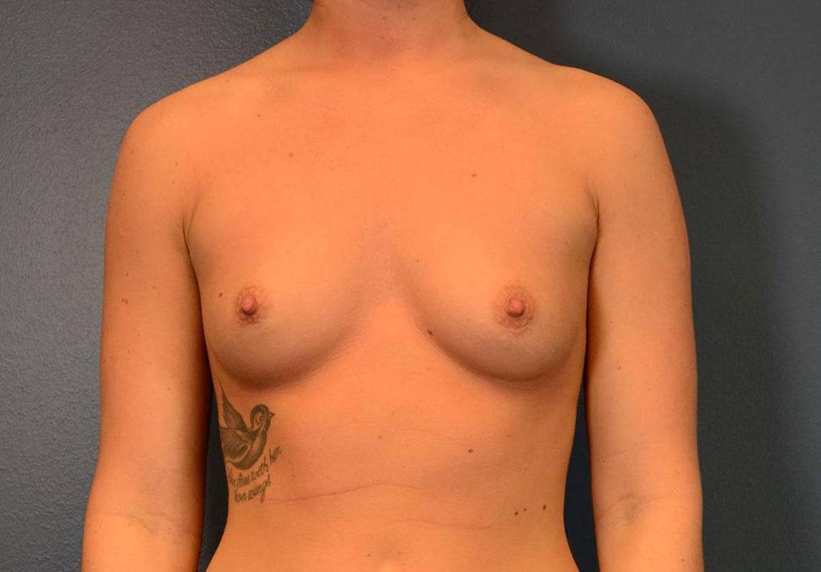 Breast Augmentation: Case BA5 Before