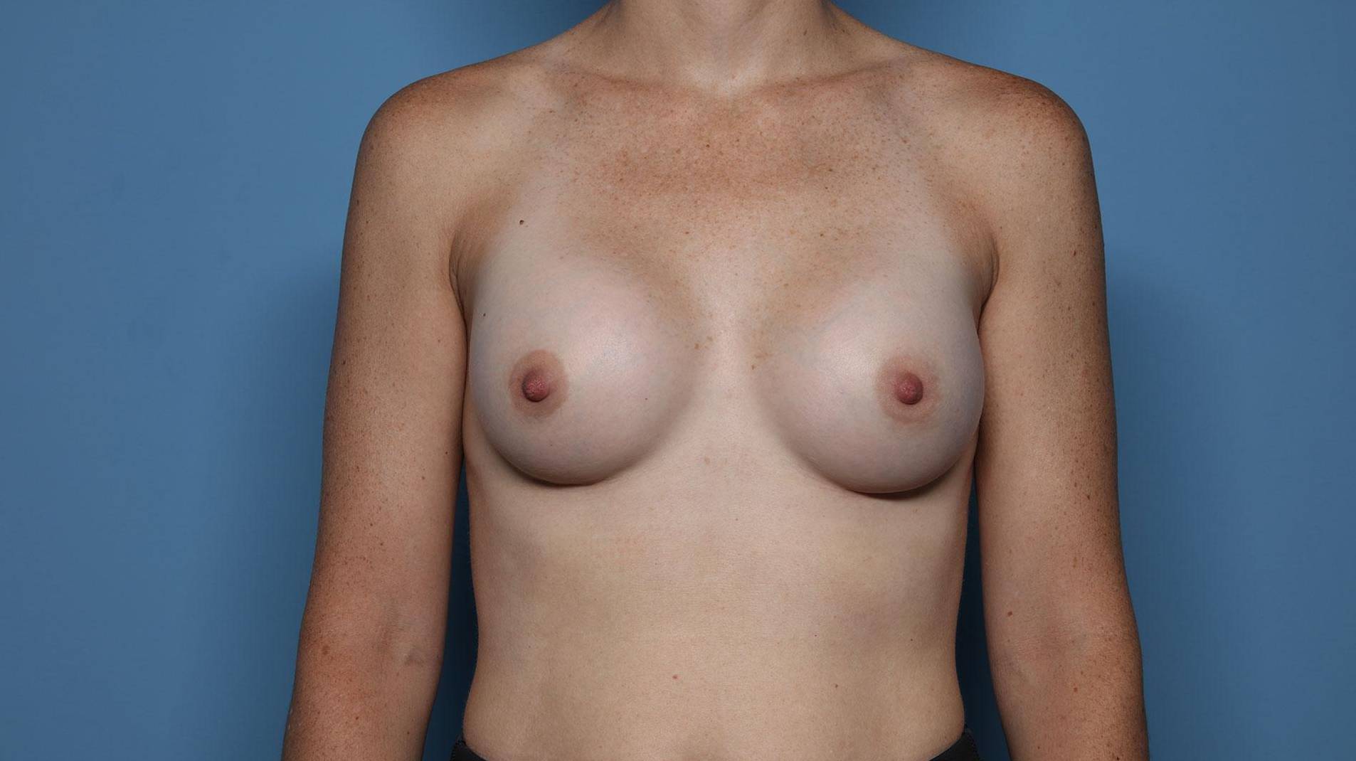 Breast Augmentation: Case BA2 After
