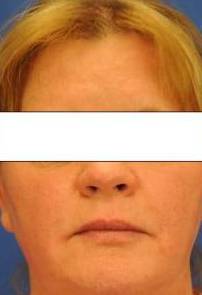 Filler to lips and marionette lines using juvederm ultra XC After