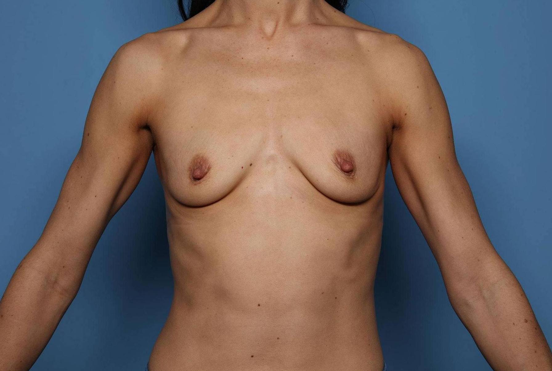 Breast Augmentation: Case BA3 Before