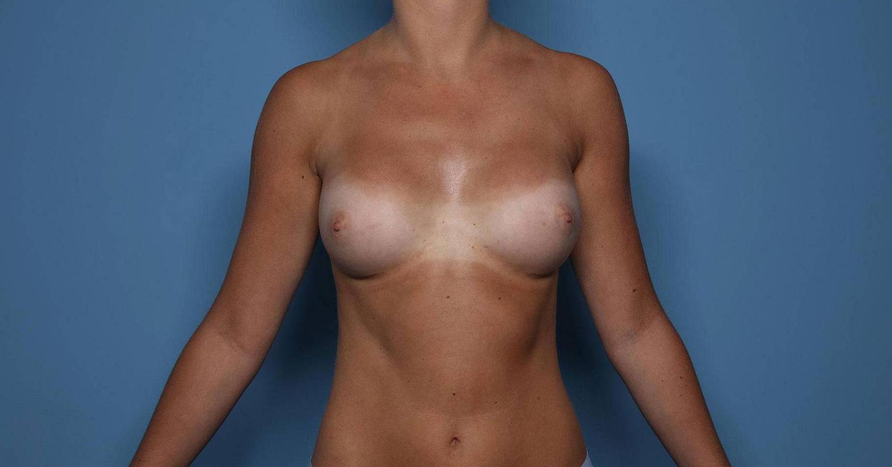 Breast Augmentation: Case BA6 After