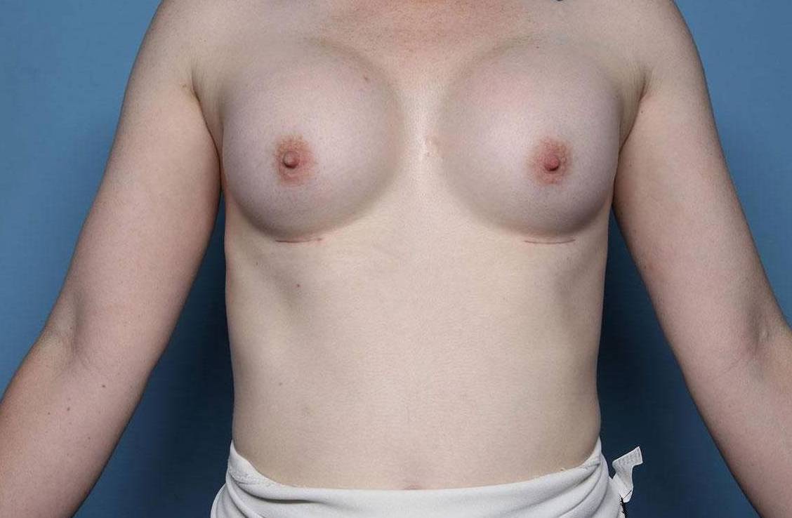 Breast Augmentation: Case BA9 After