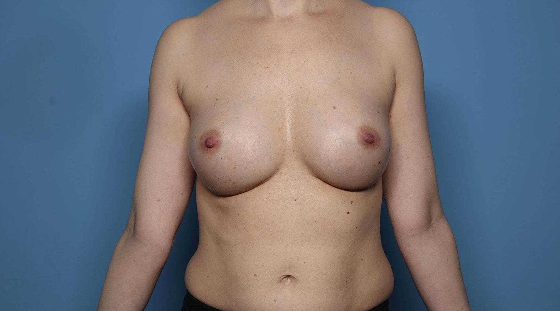 Breast Augmentation: Case BA13 Before