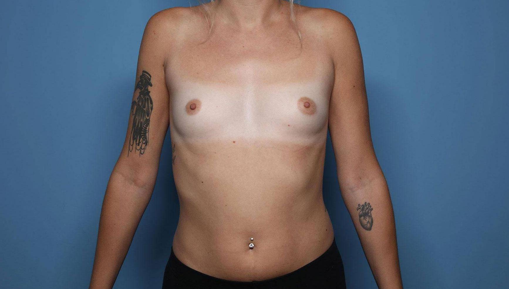 Breast Augmentation: Case BA15 Before