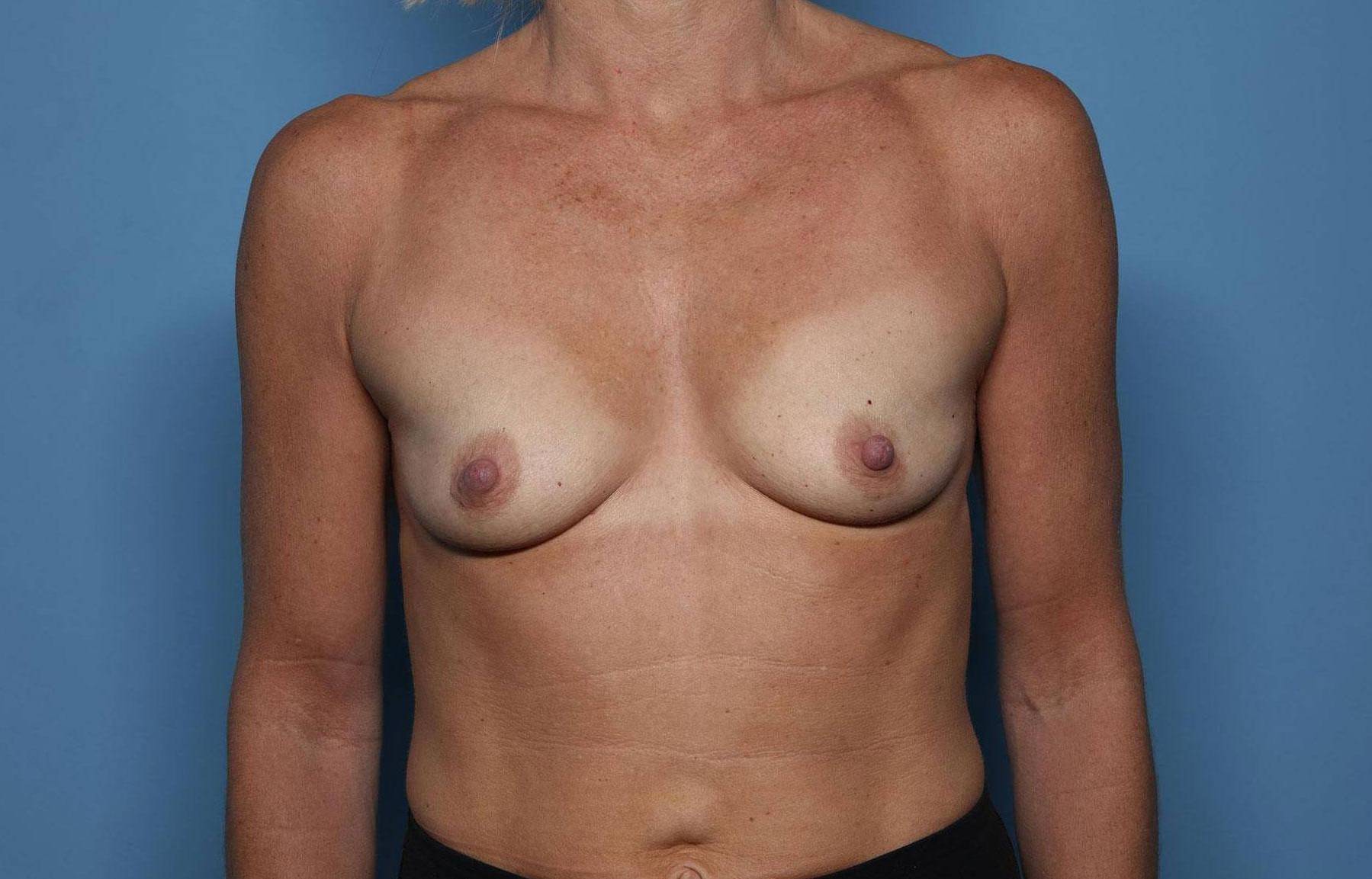 Breast Augmentation: Case BA17 Before