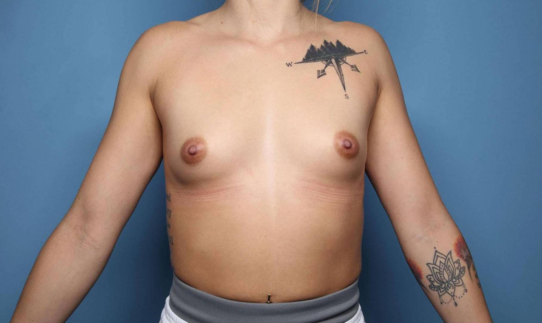 Breast Augmentation: Case BA21 Before