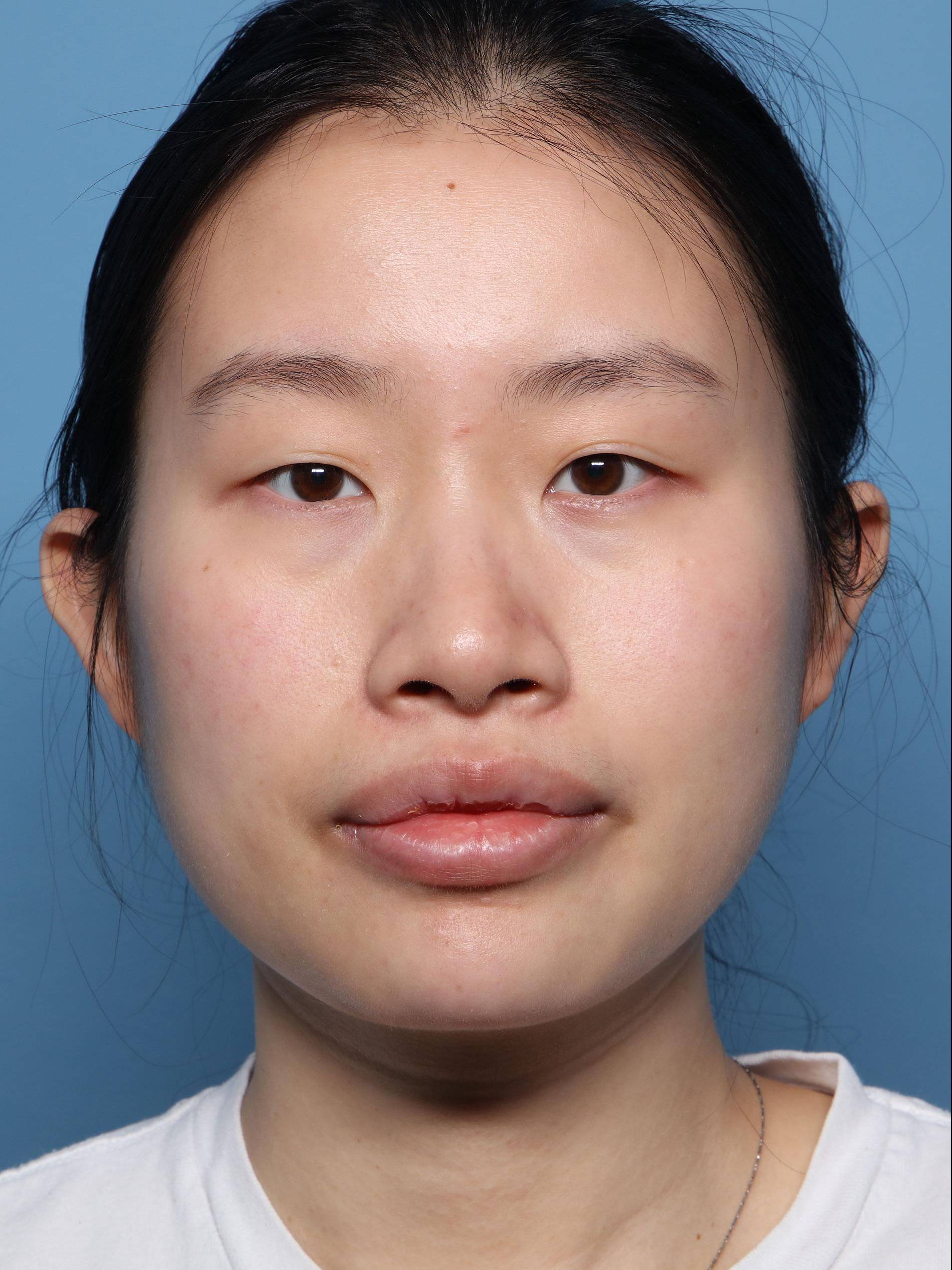 Non-Invasive Procedures and Fat Transfers: Case NI13 After